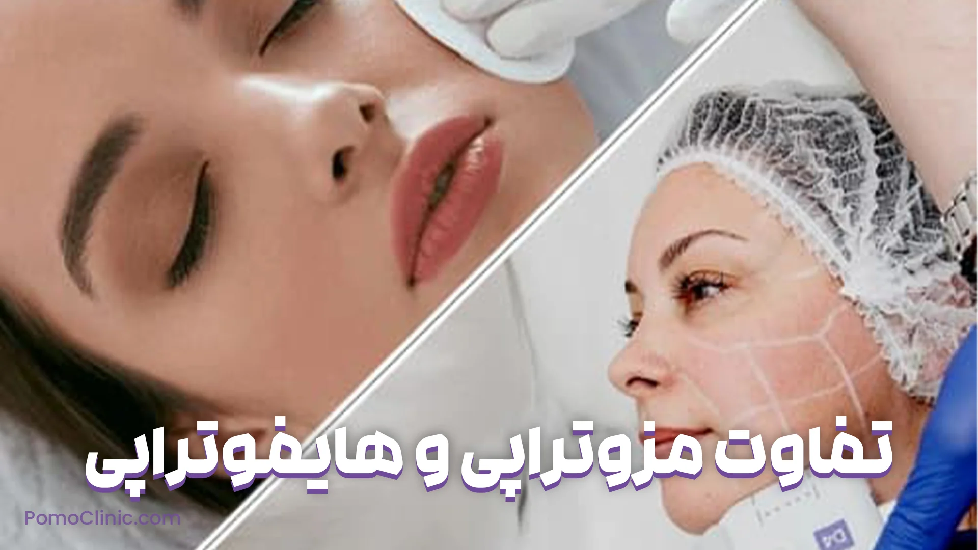 تفاوت مزوتراپی و هایفوتراپی