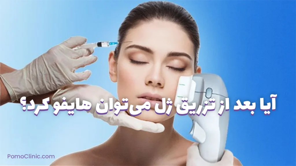 آیا بعد از تزریق ژل می‌توان هایفو کرد؟